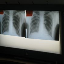 Журналистам показали, как лечат туберкулез в Харькове (ФОТО)
