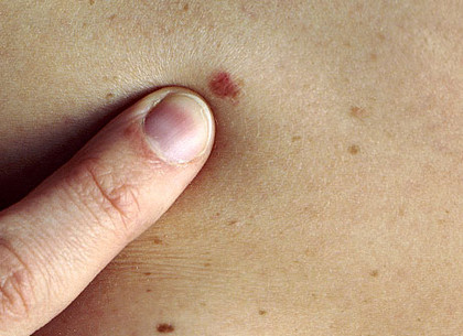 Харьковчане могут бесплатно провериться на рак кожи