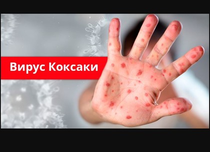Харьковчан предупредили  о вспышке вируса Коксаки (ВИДЕО)
