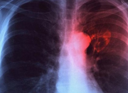 Минздрав Украины предрек  вспышку туберкулеза (ВИДЕО)